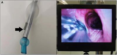 Hypoxemia in thoracoscopic lung resection surgery using a video double-lumen tube versus a conventional double-lumen tube: A propensity score-matched analysis
